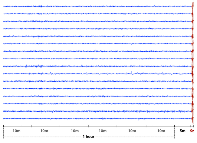 Graph showing example pre-ictal samples from the raw data [@aeskaggle].