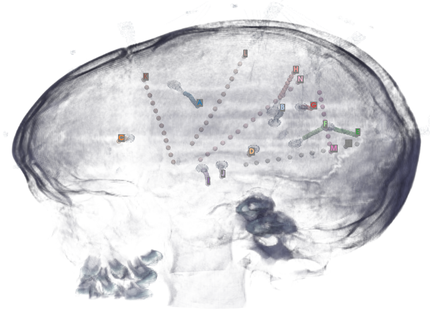 vis_electrodes_CT.png