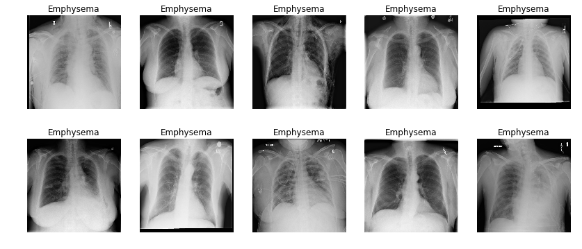 Emphysema.png