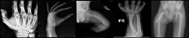 bone-fracture-7fylg.jpg